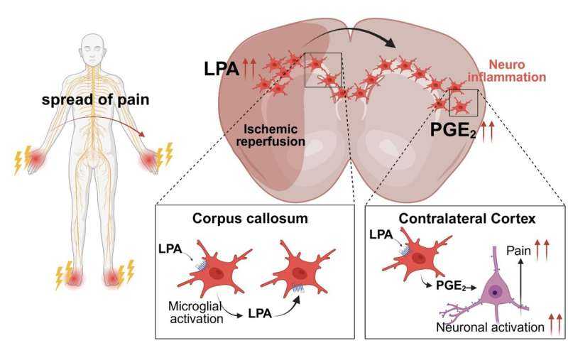 Mirror-Image Pain After Stroke May Arise from LPA-Driven Inflammation Crossing Corpus Callosum