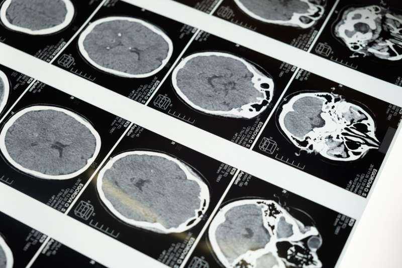 Brain tumor removal may improve blood sugar control in diabetes patients