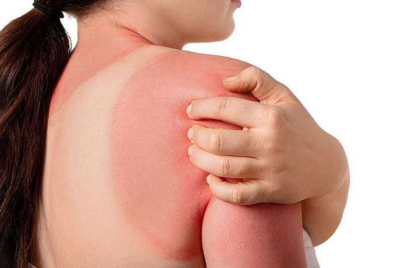 Over one-third of U.S. adults report more than one sunburn in previous 12 months