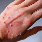 Khyber Pakhtunkhwa Enforces Smart Lockdown in Jamrud to Curb Mpox Spread​