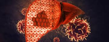 Liver Cancer Cases to Nearly Double by 2050, but Most Are Preventable