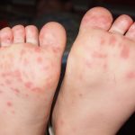Thailand Warns of Hand, Foot and Mouth Disease Outbreak as Rainy Season Begins