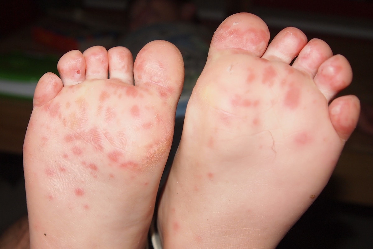 Thailand Warns of Hand, Foot and Mouth Disease Outbreak as Rainy Season Begins
