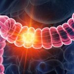 Colon Cancer Rising in Under-50s