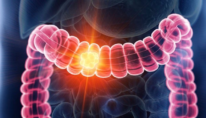 Colon Cancer Rising in Under-50s